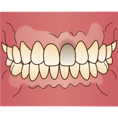 歯茎の変色